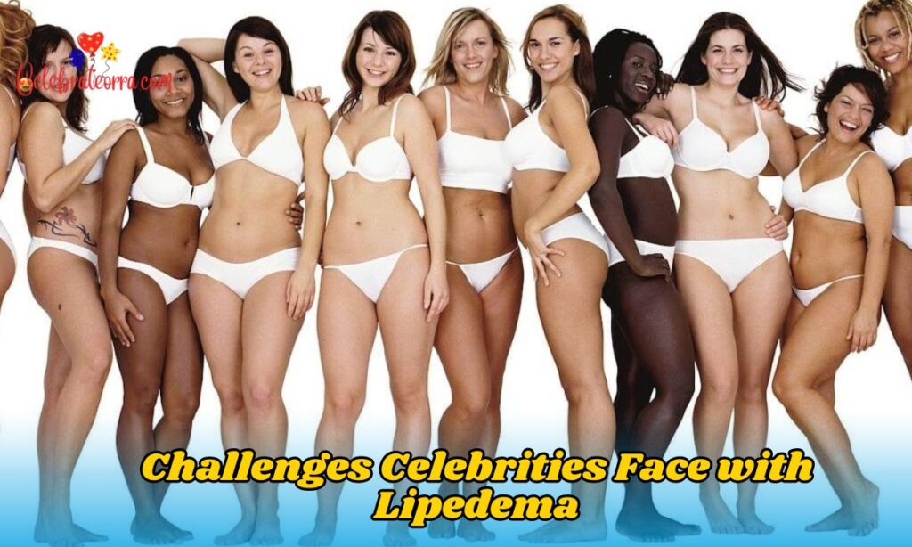 Challenges Celebrities Face with Lipedema