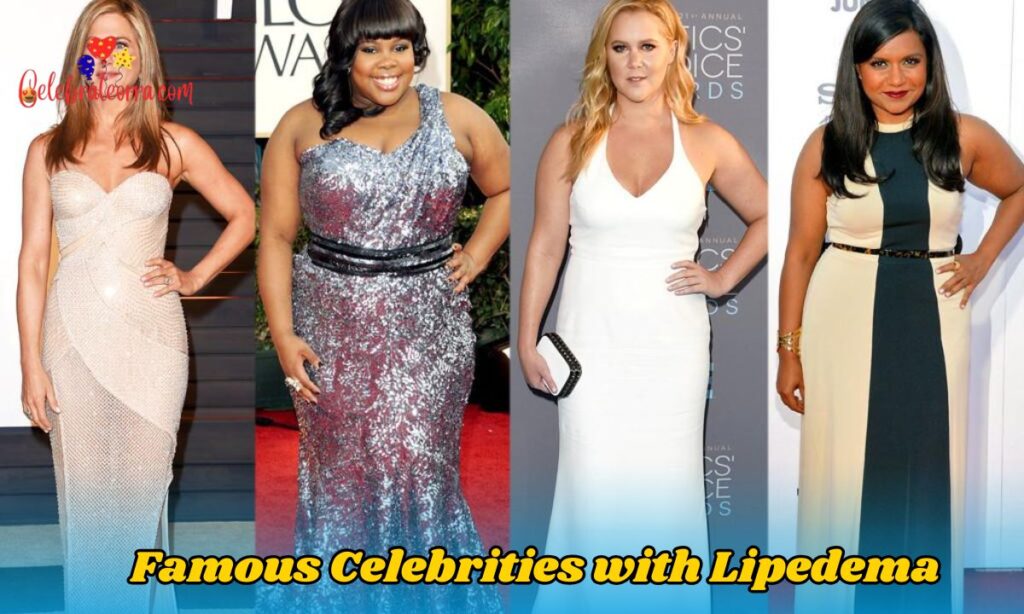 Famous Celebrities with Lipedema
