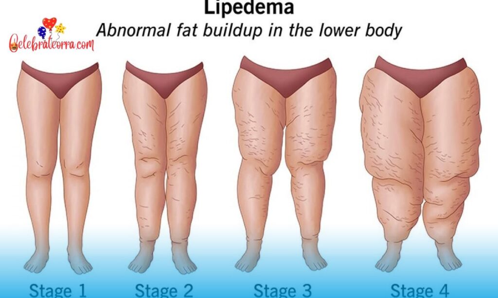What Is Lipedema